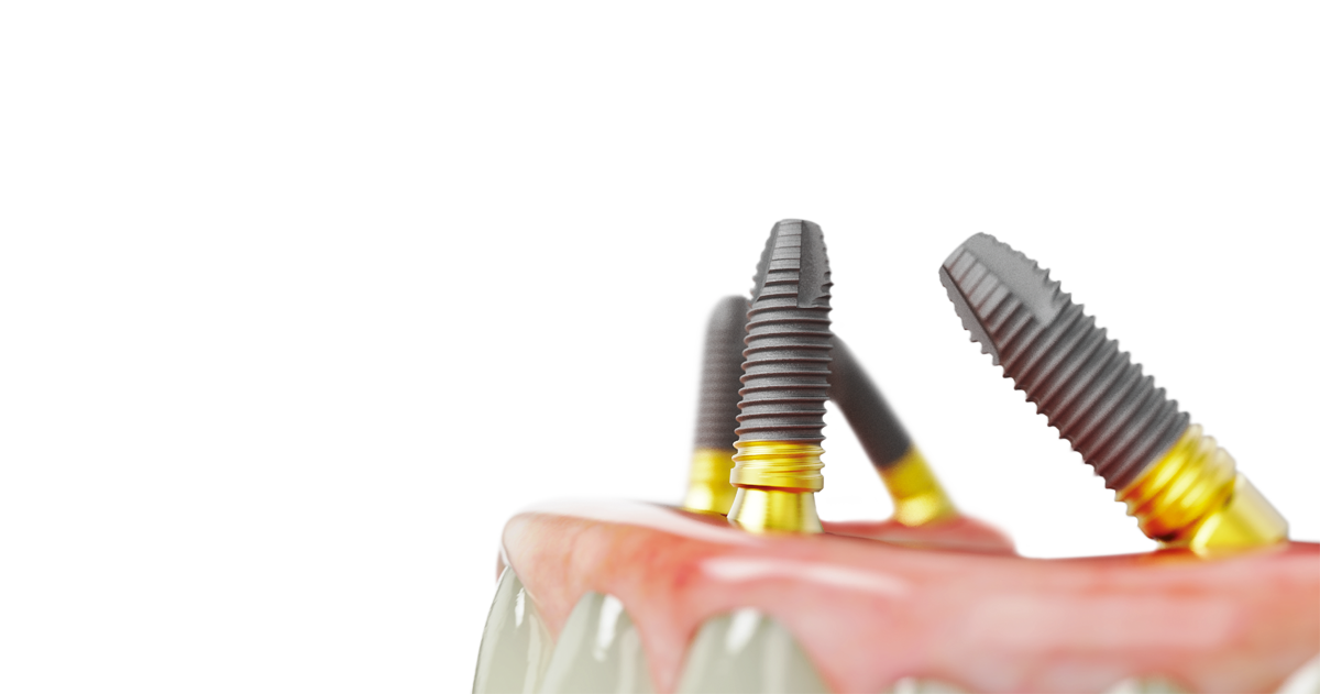 wszystkie zęby na 4 implantach